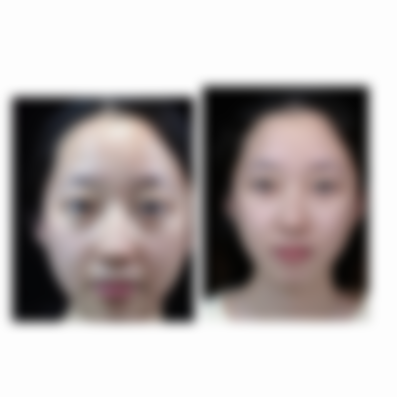 北京医院7800元的薇旖美III型胶原蛋白4mg项目顾客实例