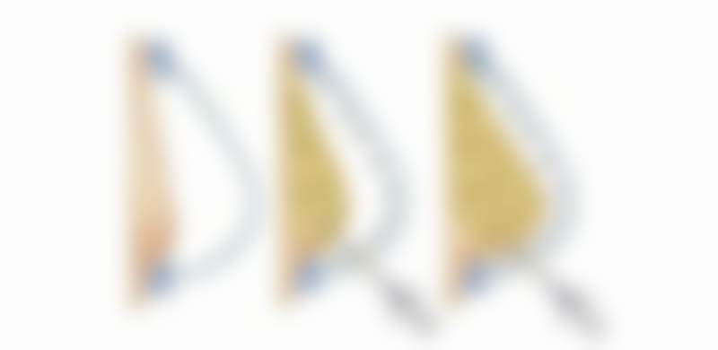 本爱医疗美容中 心艾莉薇传奇版玻尿酸优势解析