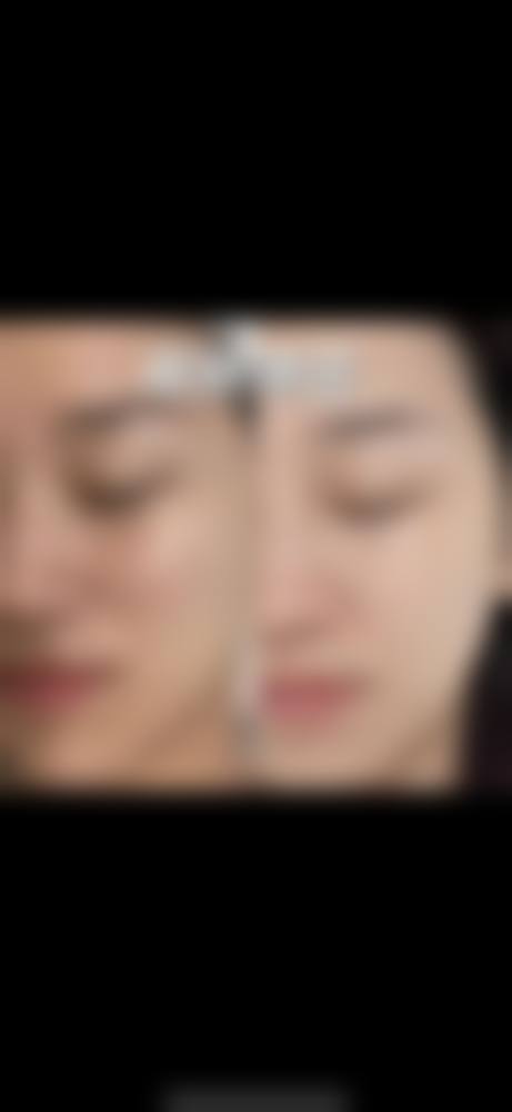 武汉斯启诺医疗美容眼部整形祛眼袋方法