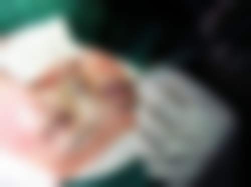 李长富医生做手术价格