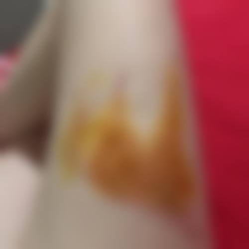 姑苏割双眼皮整形详情