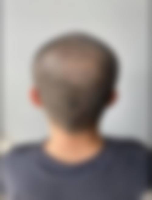 徐州新生植发怎么样——医生团队优势